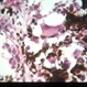 Melanoma, epithelioid cells Melanoma, epithelioid cells